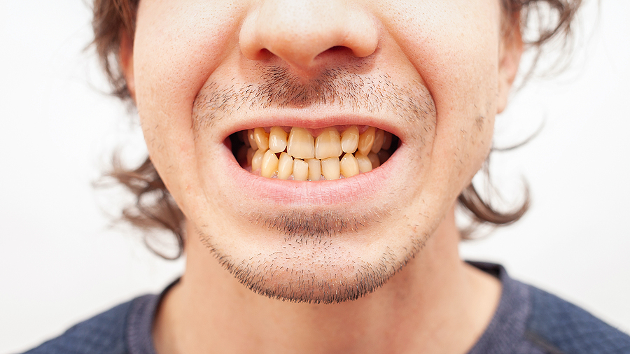 The Benefits of Zoom Bleaching